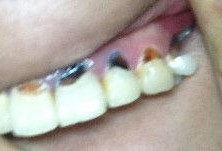 牙坏了图片,牙齿损坏的警示与护理之道