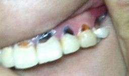 牙坏了图片,牙齿损坏的警示与护理之道