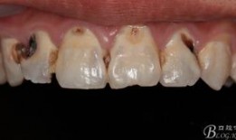 牙坏了图片,牙齿损坏的警示与护理之道