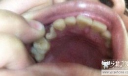 牙坏了图片,牙齿损坏的警示与护理之道